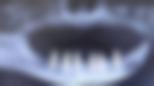 香港 澳门种植牙多少钱一个：诊所拣选要点（附香港人必睇Tips）