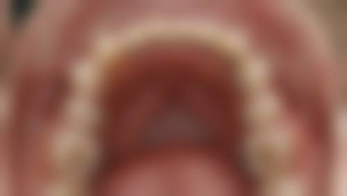 为了矫正牙齿拔牙可能存在的风险与限制