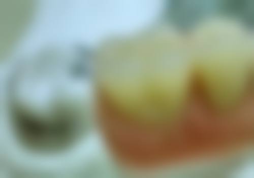 整大牙常見問題：樹脂填充vs矯正vs瓷貼面，邊樣更啱你？