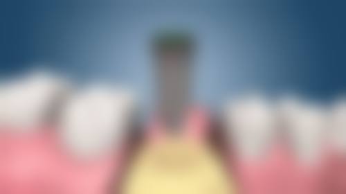 香港 格偷菲爾口腔 術前術後避坑指南！呢啲細節千祈唔好漏