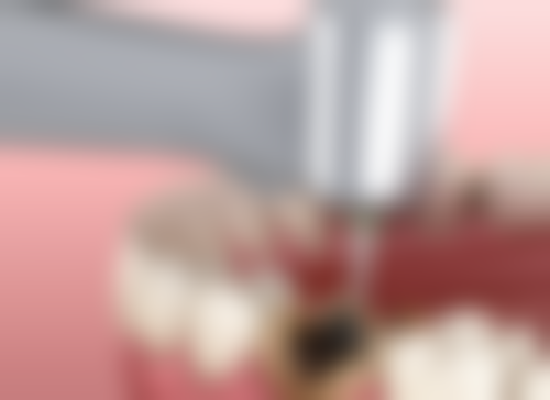 香港 vs 澳門 vs 深圳根管治療價錢大比拼