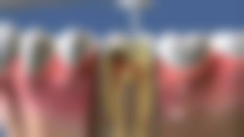 香港 澳門牙齒根管治療多少錢 價錢範圍(HKD)