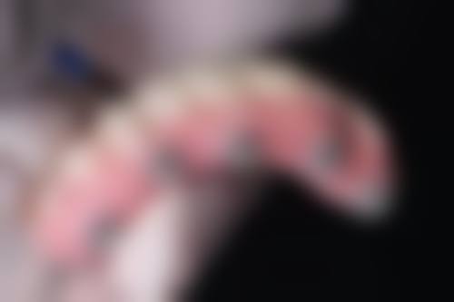 理性提醒:箍牙唔系“越平越好”,安心永远第一