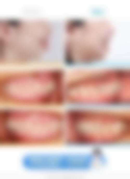 拔牙后种植牙常见并发症或后遗症，真实发生概率如何？