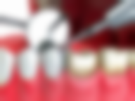 香港假牙vs深圳口岸假牙:邊度做更抵?價錢差幾多?