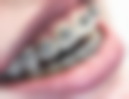 怎么判断我是否适合骨性地包天矫正项目？