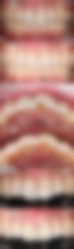 种植牙材料对比