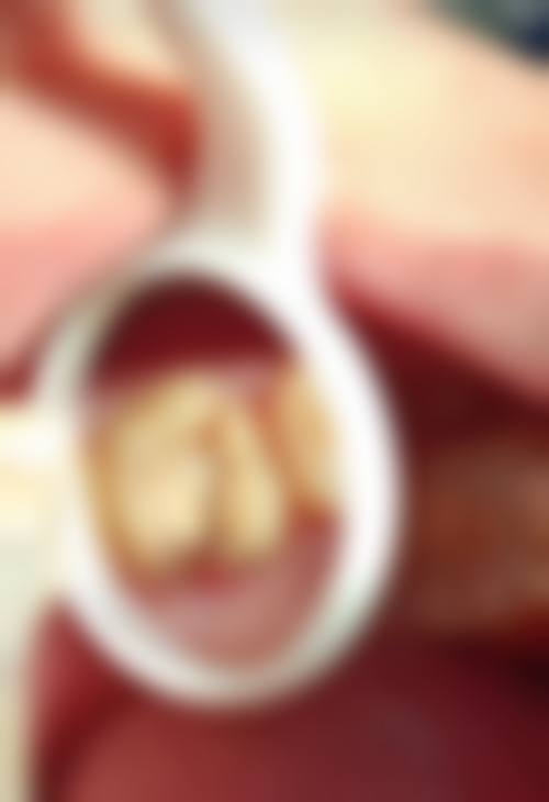 珠海根管治療醫生推薦:香港姊妹真實體驗分享