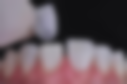 四、添悦口腔矫正价格有多划算？普通矫正3500元起，隐形矫正低至9800元！