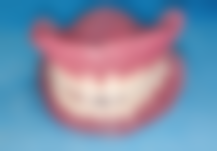 进口与国产种植牙植体在品牌和市场认可度上的区别