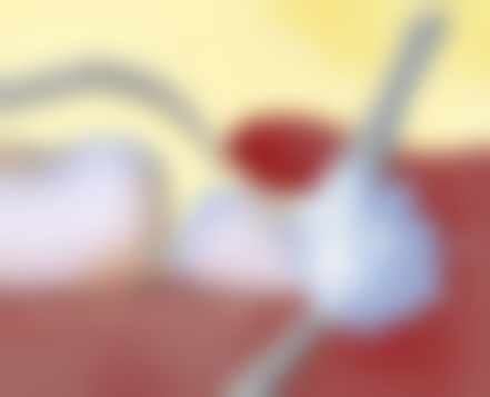 进口与国产种植牙植体在材料上的区别