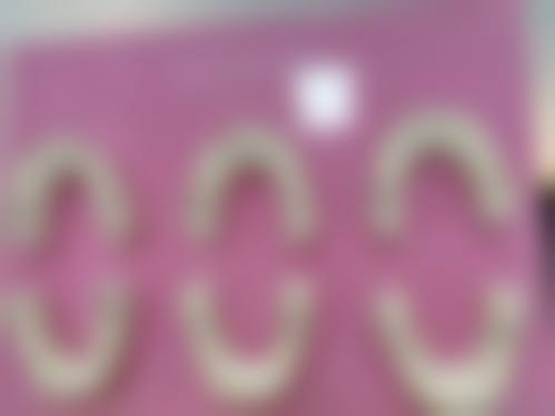 小孩矫正牙齿拔牙好还是不拔牙好