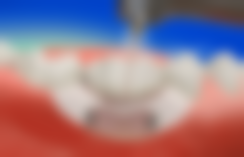 通州区叶丽萍医生鼻整形收费透明吗？无隐形消费，性价比突出