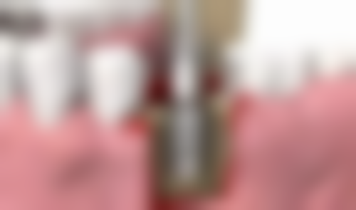 植牙项目真相：香港姊妹更关心的3个问题