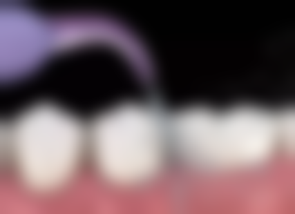 箍牙术前术后避坑指南（香港生活习惯版）