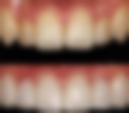 二、种植牙和镶牙的风险对比