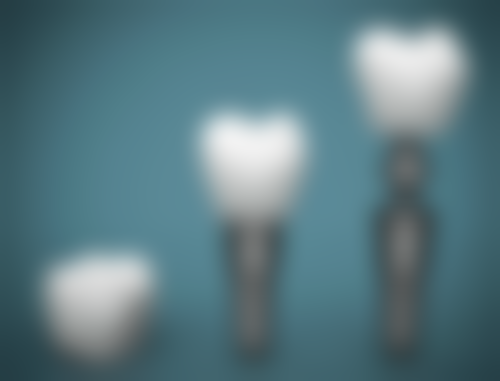 香港 種植牙過程 全新步驟：從檢查到戴牙冠全解析