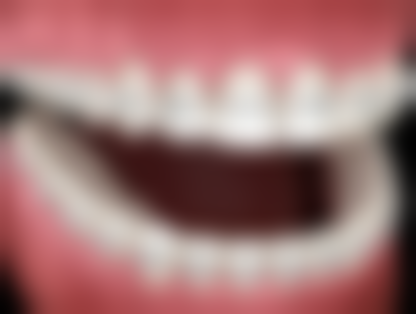 種植牙項目真相：香港人更常問嘅3個問題