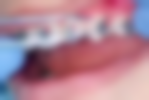 香港 深圳牙科醫院排名 價錢範圍（HKD）：同香港差幾多？附口岸实例