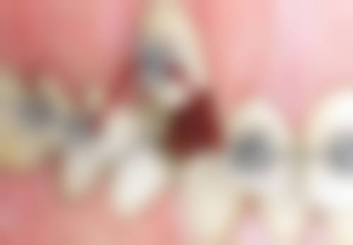 二、5岁小孩牙齿地包天矫正的3大黄金期