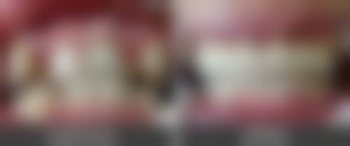 二、八十岁老人种牙需要满足哪些必备条件？