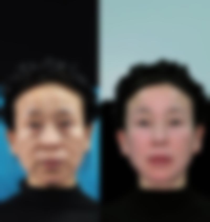 十四、黑龙江中航医院腋臭科患者常见问答