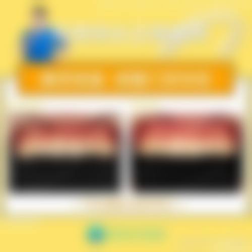 三、登腾全瓷牙冠的优势