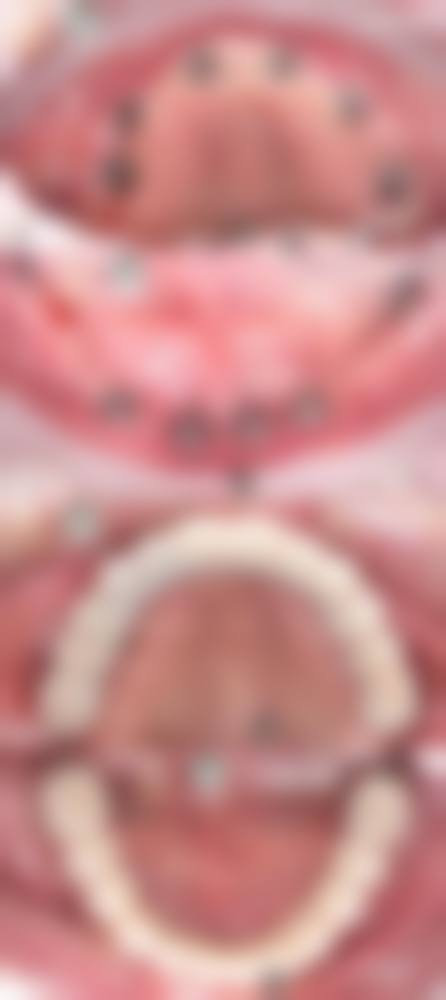 诺贝尔CC与PMC种植体有什么区别?