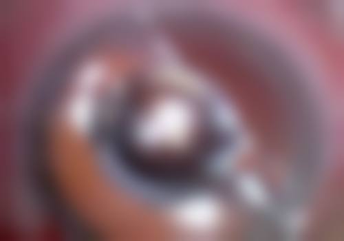 上海金山爱尔眼科医院近视手术技术优势