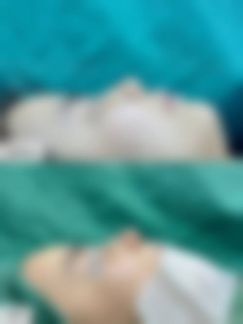 韓國隆鼻會不會一眼假 自然度關鍵：3大技術拆解