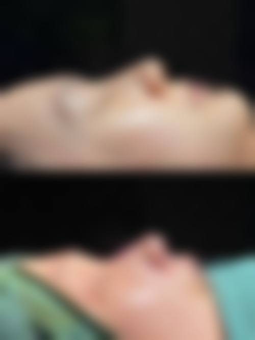 韓國隆鼻會不會一眼假 診所揀選要點：香港/澳門姊妹必睇
