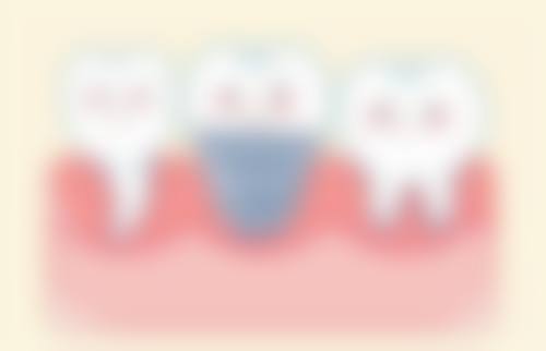 深圳缺牙多年仲可唔可以植牙 诊所拣选要点:港澳朋友过大海必睇