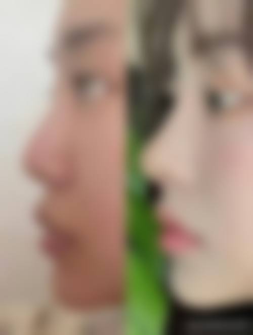韓國TS男生鼻整形好嗎 港澳男生去韓國整鼻注意事項