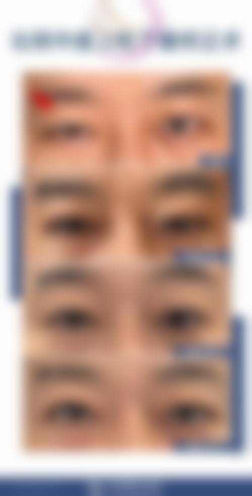 患者真实评价 - 杨雪莉 烟台市烟台山医院眼科