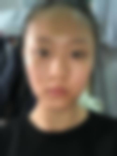 韓國鼻基底凹陷有必要做嗎 真實实例分享(香港+澳門)
