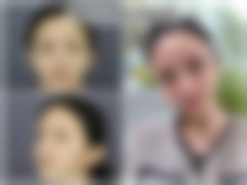 韓國鼻基底凹陷有必要做嗎？魏亨坤院長推童顏針/玻尿酸/自體脂肪2026邊個好？