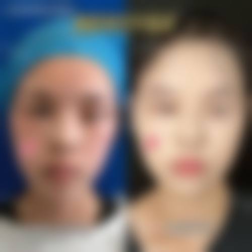 十、相关科普内容推荐:男性乳房发育症的微创治疗