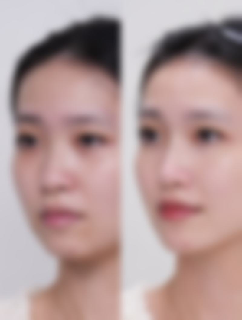 优惠活动详情——鼻综合仅需35000元起