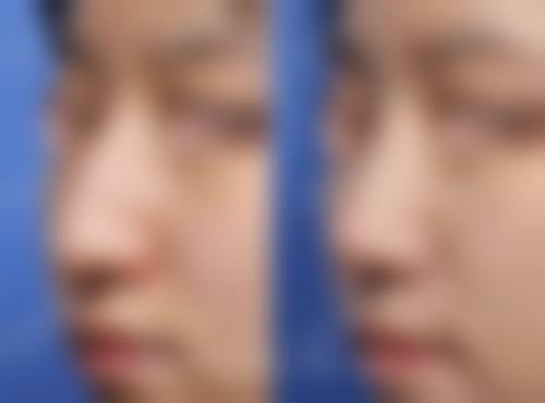四、硅胶隆鼻的风险与后遗症