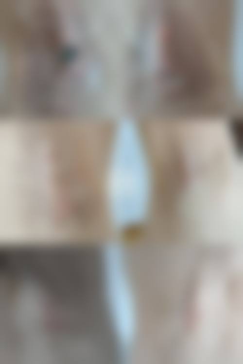 三、全切双眼皮的疤痕会全部消除吗