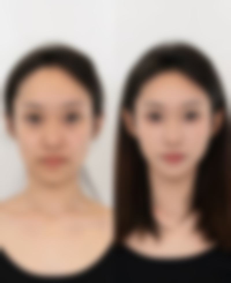 韓國醫美做完皮膚會唔會變薄？2026院長親診非流水線療程+醫生話你知真相