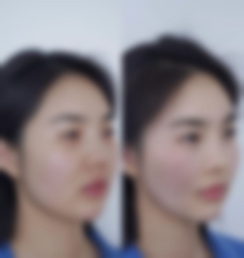 韓國輪廓恢復期真實分享2026｜磨骨削骨術後7日消腫+30日恢復全記錄！