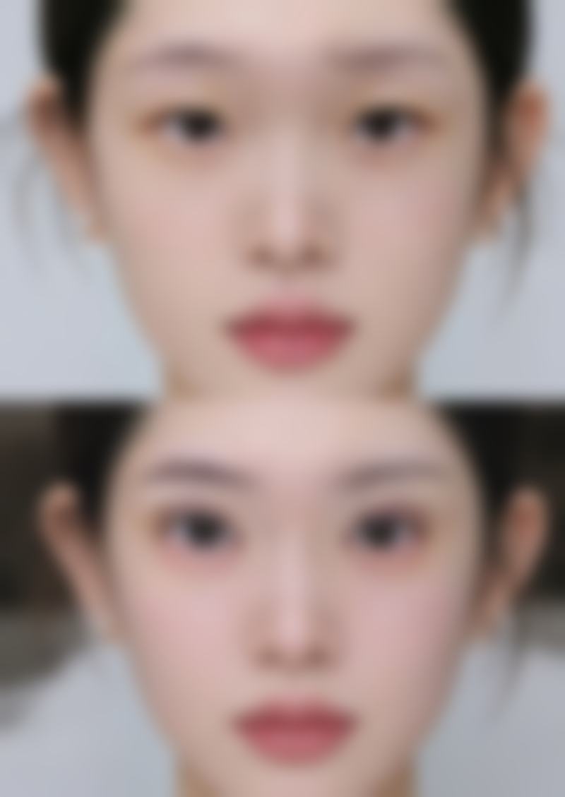 韓國輪廓恢復期真實分享:術後7日消腫全記錄
