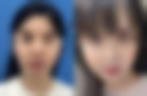 韓國GNG價錢透明嗎？2026最新隆鼻費用表公開605-1100萬韓幣起洪晟文醫生點評