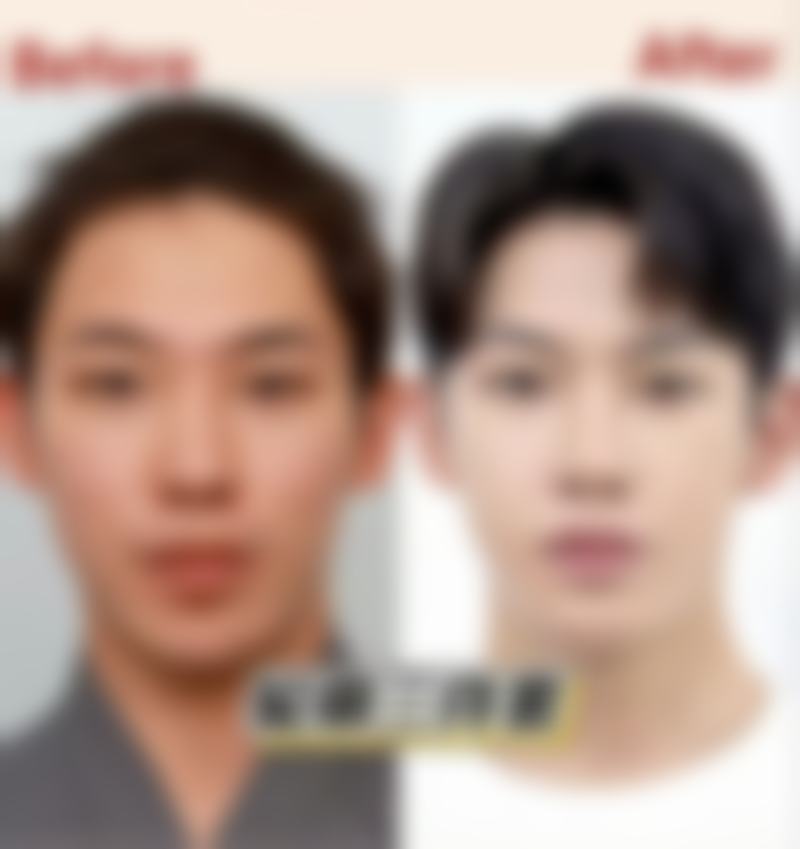 韓國Banobagi雙眼皮推薦:術前術後避坑指南