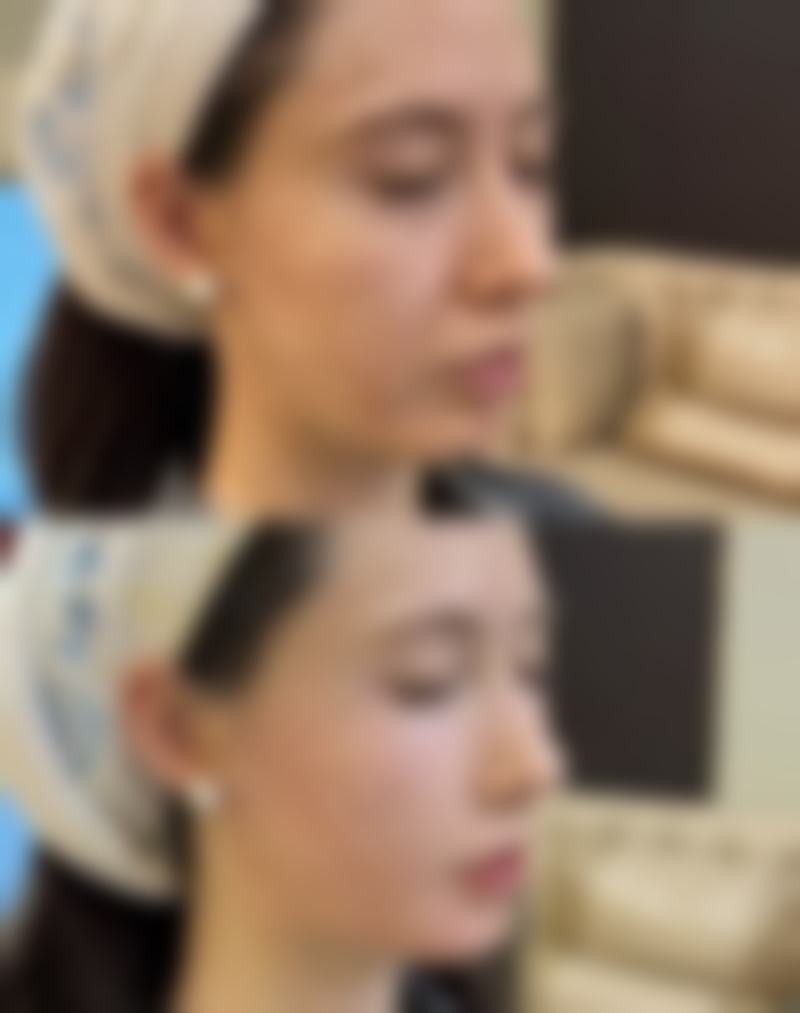 韓國Banobagi雙眼皮推薦:適合邊類人群?