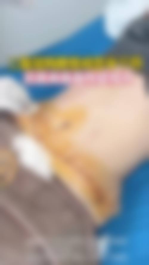 医生们怎么说肚子抽脂后同房时间