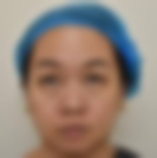 三、德国热熔去眼袋成效能维持多久
