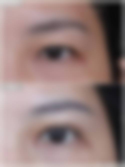 五、德国热熔眼袋技术的缺点