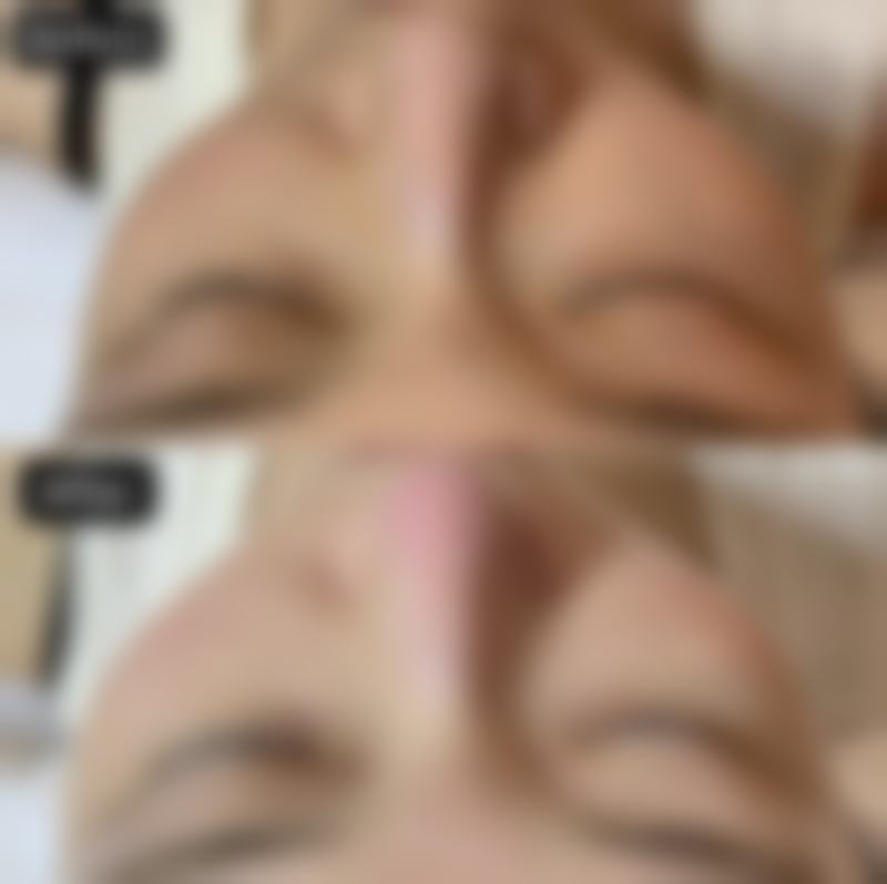 韓國鼻整形真實心得：適合邊類人群？
